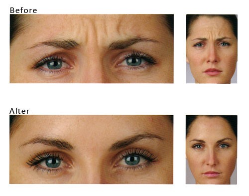 Botox - przed i po