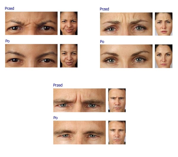 Botox - przed i po